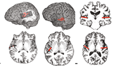 Images of brains with speech areas activated.