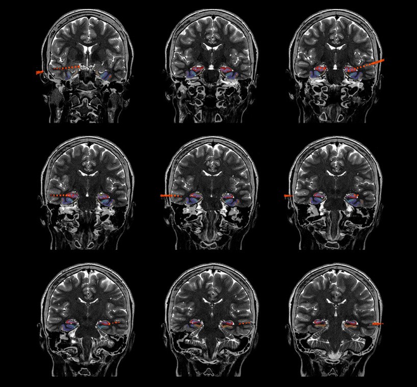 View of deep-brain electrodes surgically implanted in a patient with drug-resistant epilepsy (courtesy of Josh Jacobs)