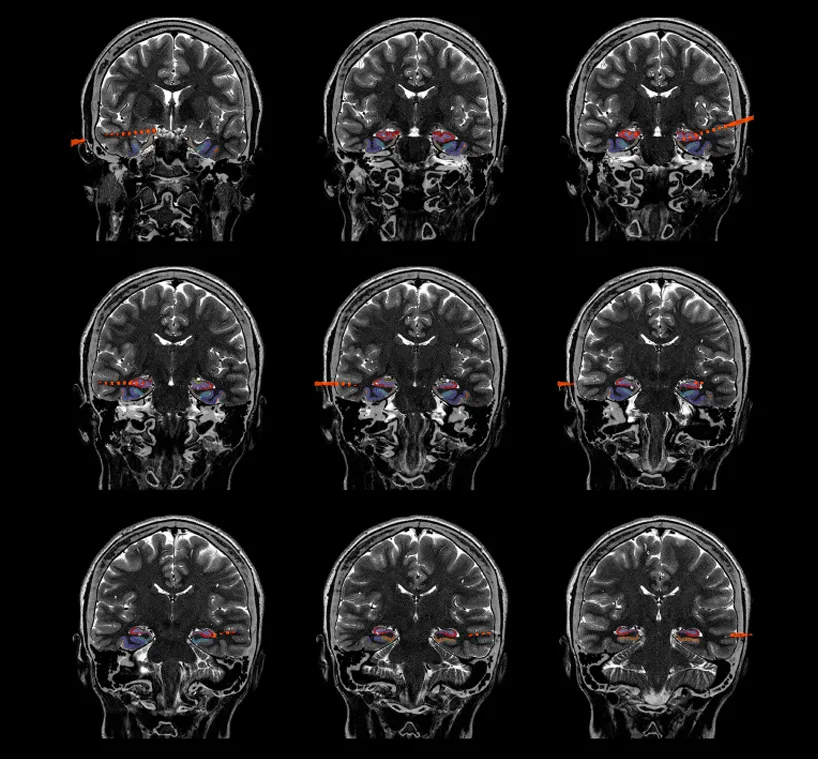 View of deep-brain electrodes surgically implanted in a patient with drug-resistant epilepsy (courtesy of Josh Jacobs)